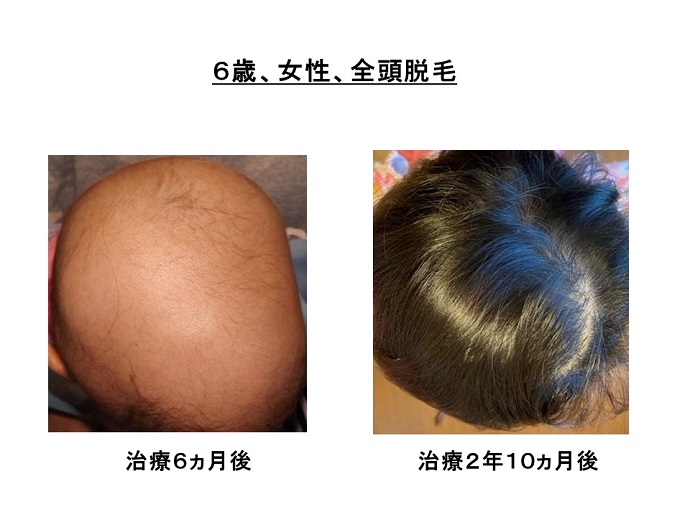 円形脱毛症　病院